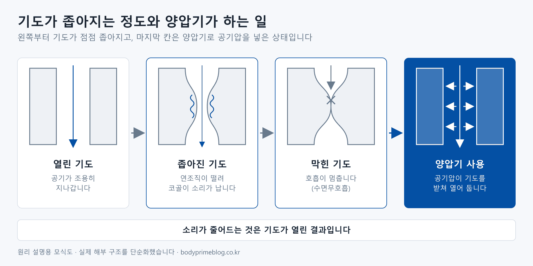 기도가 좁아지는 정도에 따른 네 단계 모식도. 열린 기도는 공기가 조용히 지나가고, 좁아진 기도는 연조직이 떨려 코골이 소리가 나며, 막힌 기도는 호흡이 멈추는 수면무호흡 상태다. 마지막 칸은 양압기가 공기압으로 기도를 받쳐 열어 둔 상태다.