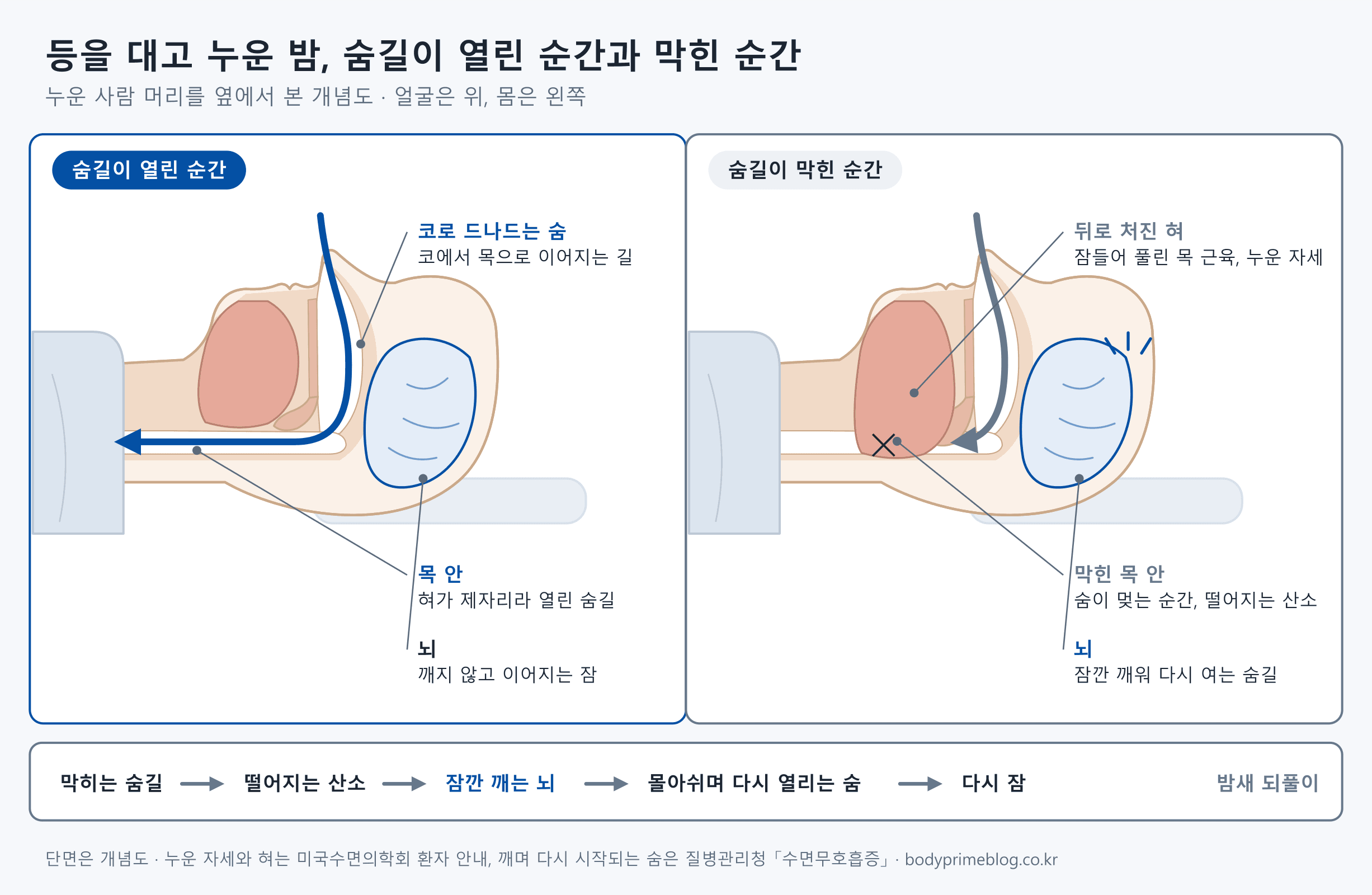 등을 대고 누운 사람의 머리를 옆에서 자른 개념도 두 장입니다. 숨길이 열린 순간에는 코로 들어온 숨이 목 안으로 이어지고 혀가 제자리에 있어 뇌가 깨지 않고 잠이 이어집니다. 숨길이 막힌 순간에는 잠들어 풀린 목 근육과 누운 자세 때문에 혀가 뒤로 처져 목 안을 막고, 숨이 멎으며 산소가 떨어지면 뇌가 잠깐 깨워 숨길을 다시 엽니다. 아래 띠에는 막히는 숨길, 떨어지는 산소, 잠깐 깨는 뇌, 몰아쉬며 다시 열리는 숨, 다시 잠이 밤새 되풀이되는 고리가 그려져 있습니다.