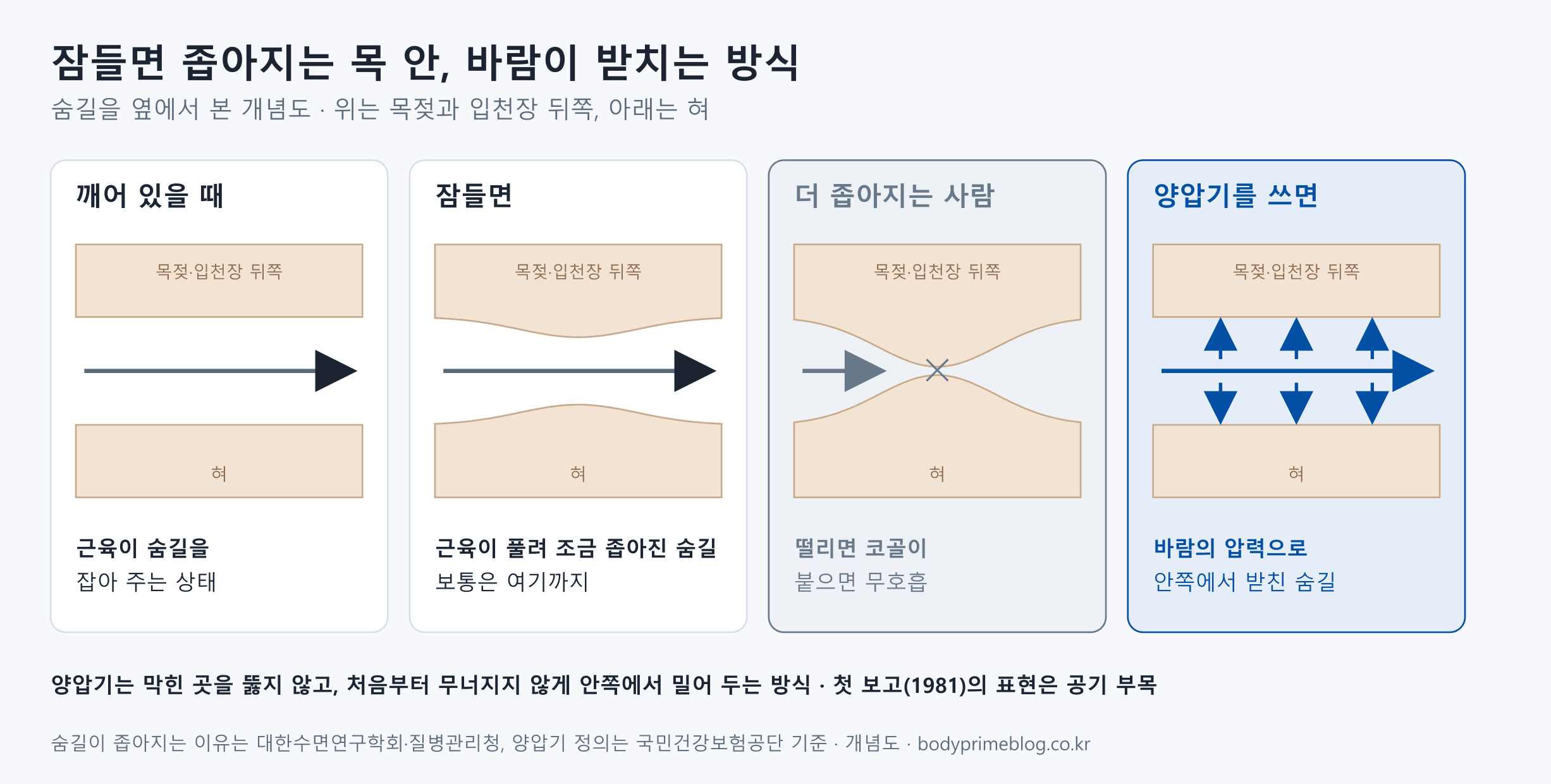 숨길을 옆에서 본 개념도 네 칸입니다. 깨어 있을 때는 근육이 숨길을 잡아 주어 넓게 열려 있습니다. 잠들면 근육이 풀려 목젖과 입천장 뒤쪽, 혀가 처지며 숨길이 조금 좁아지는데 보통은 여기까지입니다. 더 좁아지는 사람은 좁아진 곳이 떨리면 코골이가 되고, 위아래가 붙으면 숨이 멎습니다. 양압기를 쓰면 마스크로 들어온 바람의 압력이 안쪽에서 벽을 받쳐 숨길이 열린 채로 유지됩니다. 1981년 첫 보고는 이를 공기 부목이라고 불렀습니다.