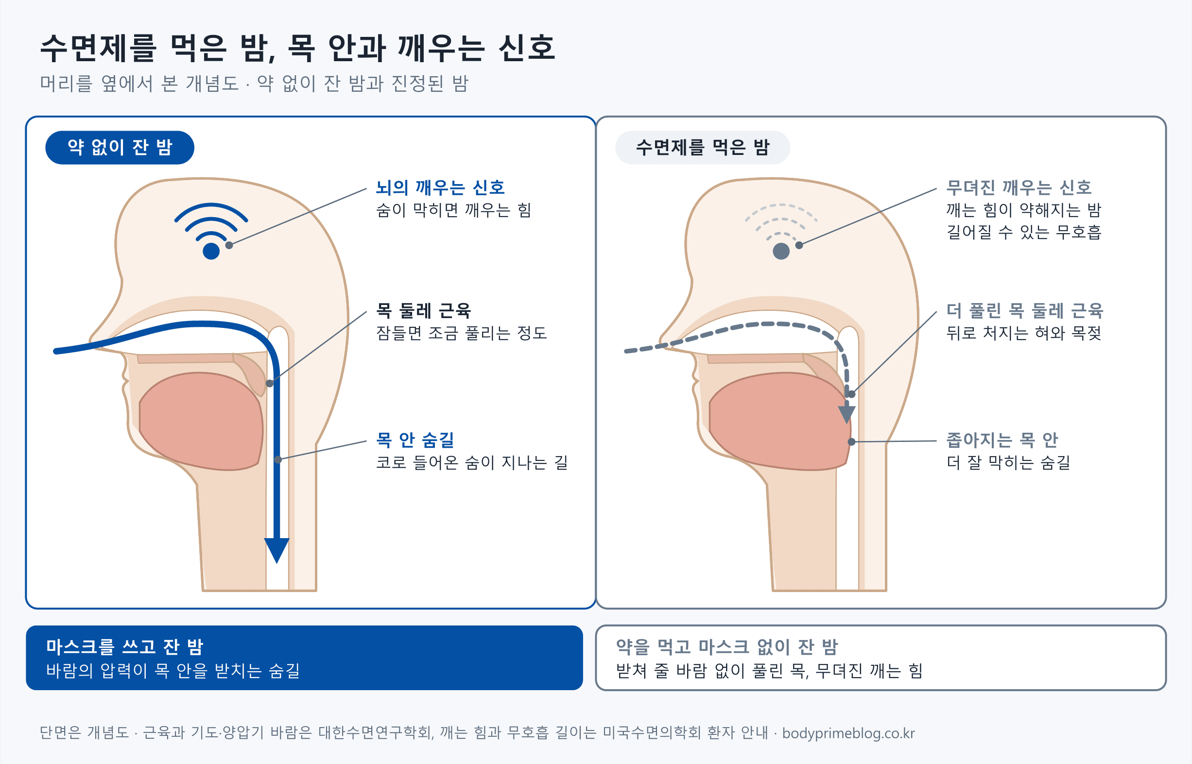 머리를 옆에서 본 단면 두 장면입니다. 약 없이 잔 밤에는 혀와 목젖이 제자리에 있어 코로 들어온 숨이 목 안을 지나고, 숨이 막히면 뇌가 깨우는 신호가 또렷합니다. 수면제를 먹은 밤에는 목 둘레 근육이 더 풀려 혀와 목젖이 뒤로 처지고 목 안이 좁아지며, 깨우는 신호가 무뎌져 무호흡이 길어질 수 있습니다. 아래 띠는 마스크를 쓰고 잔 밤은 바람의 압력이 목 안을 받치고, 약을 먹고 마스크 없이 잔 밤은 받쳐 줄 바람이 없다는 비교입니다. 근육과 기도는 대한수면연구학회, 깨는 힘은 미국수면의학회 환자 안내를 근거로 한 개념도입니다.