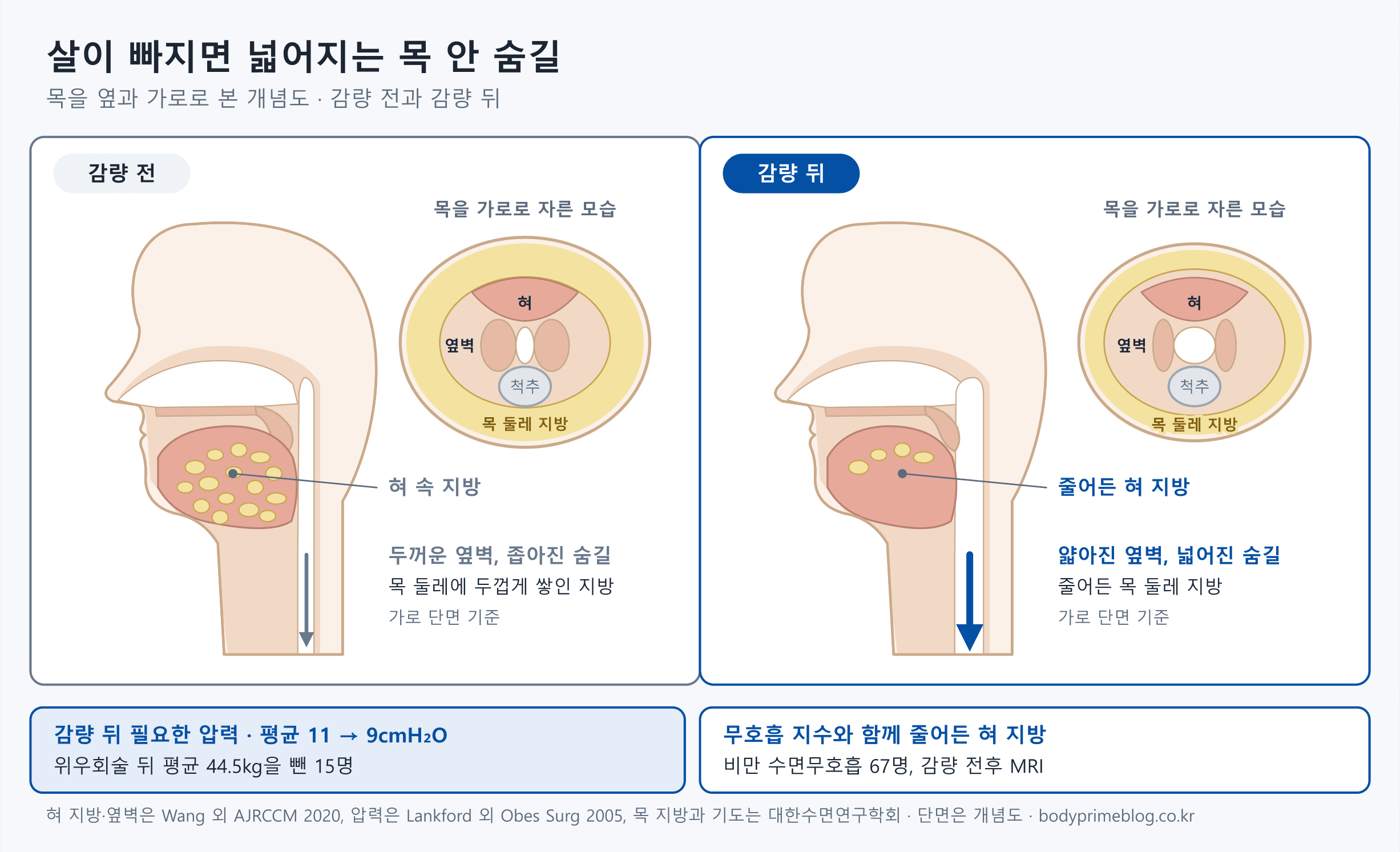 목을 옆과 가로로 본 개념도로 감량 전과 감량 뒤를 비교합니다. 감량 전에는 혀 속 지방이 많고 목 옆벽과 목 둘레 지방이 두꺼워 숨길이 좁습니다. 감량 뒤에는 혀 지방이 줄고 옆벽이 얇아져 숨길이 넓어집니다. 아래에는 위우회술 뒤 평균 44.5kg을 뺀 15명의 필요 압력이 평균 11에서 9cmH₂O로 내려갔다는 점과, 비만 수면무호흡 67명의 감량 전후 MRI에서 혀 지방이 무호흡 지수와 함께 줄었다는 점이 적혀 있습니다.