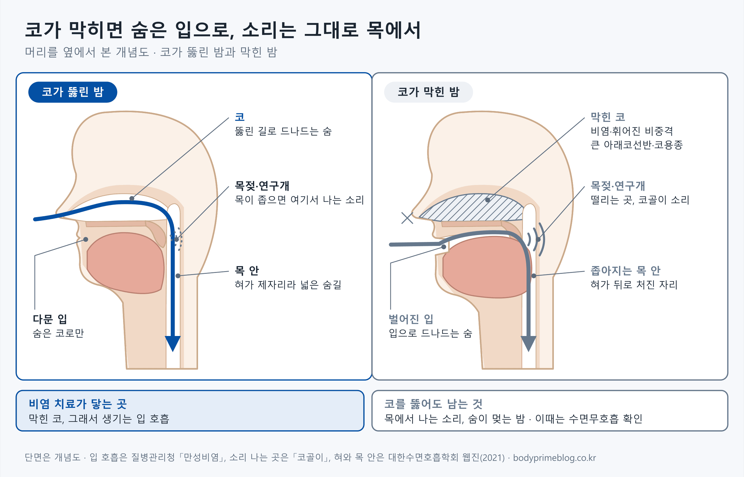 머리를 옆에서 본 개념도 두 장입니다. 코가 뚫린 밤에는 숨이 코로 들어와 목으로 내려가고, 입은 다문 채 혀는 제자리에 있으며, 목이 좁으면 목젖과 연구개 쪽에서 소리가 날 수 있습니다. 코가 막힌 밤에는 비염, 휘어진 비중격, 큰 아래코선반, 코용종으로 콧속이 막혀 숨이 벌어진 입으로 들어오고, 혀가 뒤로 처지며 목 안이 좁아지고 목젖과 연구개가 떨려 코골이 소리가 납니다. 아래에는 비염 치료가 닿는 곳은 막힌 코와 그로 인한 입 호흡이고, 코를 뚫어도 목에서 나는 소리와 숨이 멎는 밤은 남을 수 있어 이때는 수면무호흡을 확인한다고 적혀 있습니다.